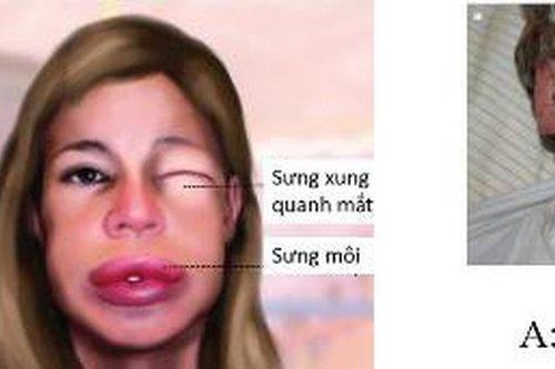 Phù mạch di truyền làm gì để kiểm soát?