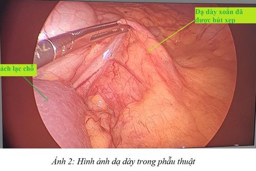 Cấp cứu bệnh nhân xoắn dạ dày 180 độ, lách, thận nằm lạc chỗ