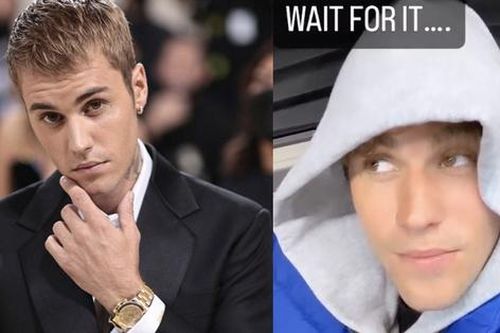 Tình trạng liệt nửa mặt của Justin Bieber hiện ra sao?