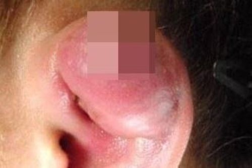 Sưng nề, chảy mủ khi bấm khuyên ở vành tai