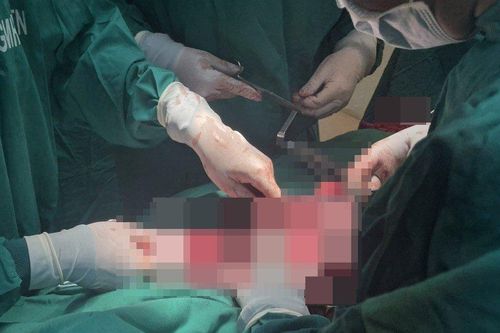 Đắk Lắk: Lần đầu tiên phẫu thuật thành công bướu giáp thòng hiếm gặp
