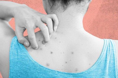 Các biện pháp giảm mụn lưng tự nhiên giúp chị em tự tin chào hè