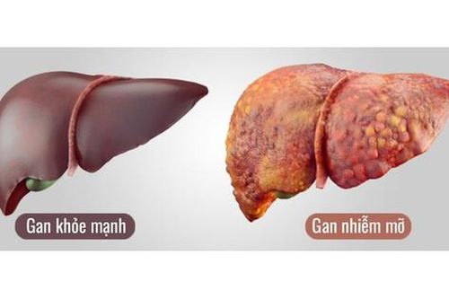 Mới 35 tuổi đã bị gan nhiễm mỡ độ 3, người đãn ông 'ngã ngửa' khi biết nguyên nhân