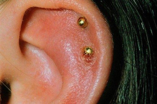 Nữ sinh bị biến dạng tai sau khi bấm lỗ tai