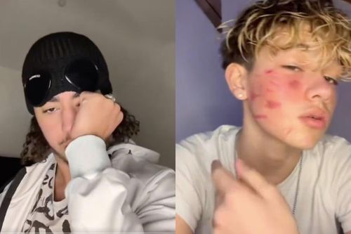 Thử thách độc hại 'French scar' khiến TikTok bị điều tra