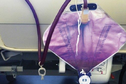 Lý do khiến cụ bà 76 tuổi đi ra nước tiểu màu tím kỳ lạ