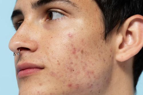 Bị mụn trứng cá, ăn gì để nhanh khỏi?