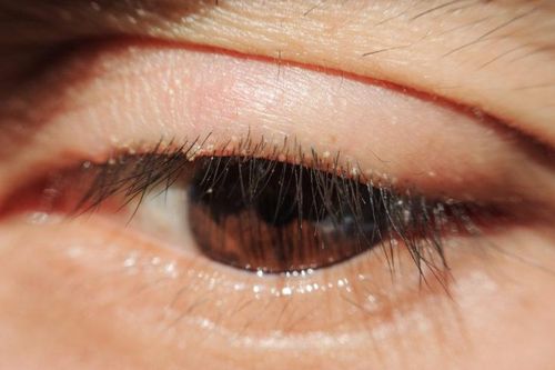 Các phương pháp trị viêm bờ mi mắt