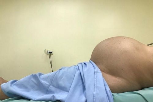 Ngỡ bụng to do béo, người phụ nữ đi khám mới sững sờ khi biết có u tử cung gần 10kg