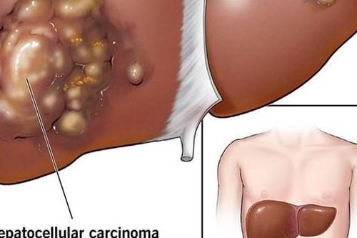 7 nhóm đối tượng cần đi tầm soát ung thư gan sớm