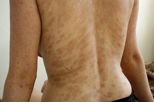 Trợt da, loét vùng sinh dục do dị ứng thuốc