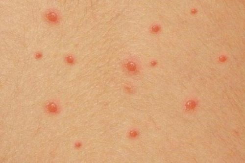 Loại virus có thể 'ngủ đông' trong tủy sống