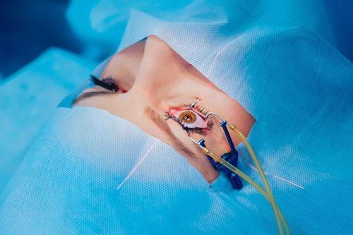 Những điều cần biết trước khi phẫu thuật Lasik chữa cận thị