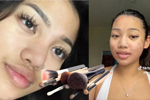 Cô gái 22 tuổi nhiễm hắc lào khắp mặt do dùng chung cọ trang điểm