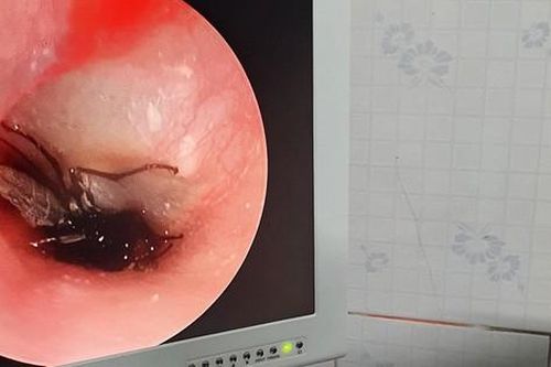 Bé trai khóc thét cả đêm vì gián chui vào tai