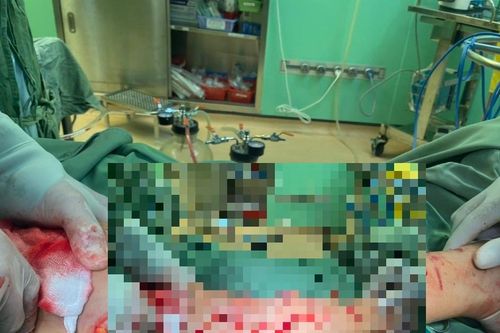 Bệnh viện Bà Rịa: Mổ cấp cứu 1 bệnh nhân bị chó cắn đa vết thương