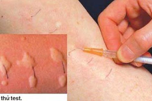 Dị ứng thuốc kháng sinh và cách giảm nguy cơ dị ứng