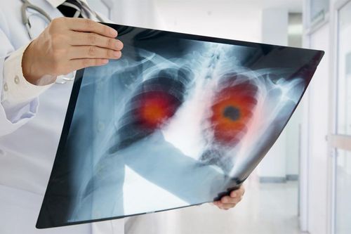 Bệnh nhân ung thư di căn có thể sống thêm bao nhiêu lâu?