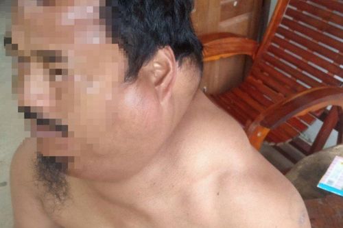 Đà Nẵng: Phẫu thuật lấy 4 kg mỡ của người đàn ông bị bệnh lạ hiếm gặp