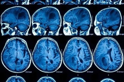 Triển vọng mới cho phương pháp điều trị ưng thư não