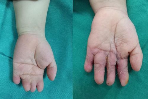 Tách thành công 4 ngón tay bị dính bẩm sinh