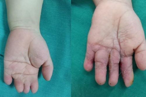 Tách thành công 4 ngón tay bị dính bẩm sinh cho trẻ 4 tuổi