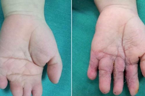 Em bé chào đời với bàn tay bị dính liền 4 ngón