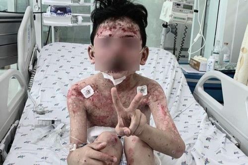 Bé trai bỗng mắc 'hội chứng lạ' sau 2 ngày ăn thịt cua