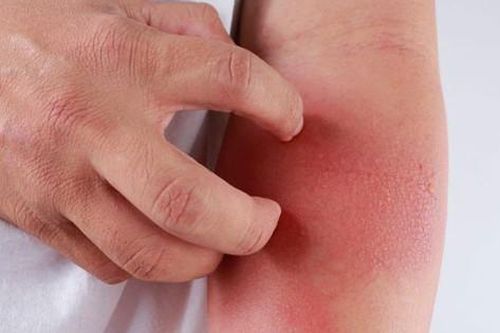 Cách phòng bệnh viêm da mủ khi thời tiết nóng nực