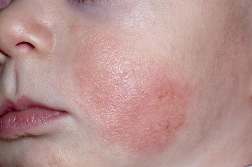 Cách điều trị chàm da ở trẻ