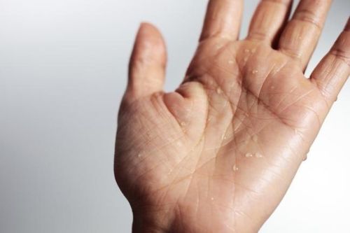 Ra nhiều mồ hôi có phải là bệnh?