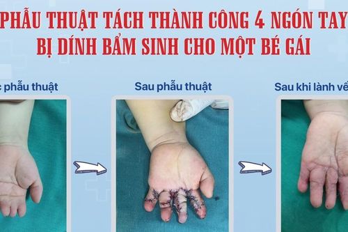 Bệnh viện Sản Nhi Nghệ An phẫu thuật tách thành công 4 ngón tay bị dính bẩm sinh cho trẻ