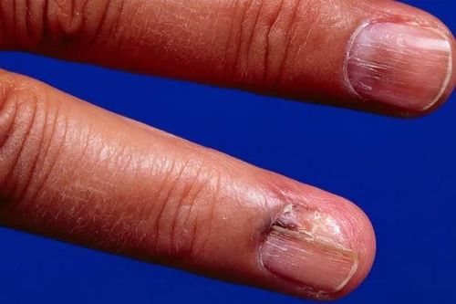 5 dấu hiệu khó nhận biết của ung thư da và lời kêu gọi của chuyên gia da liễu