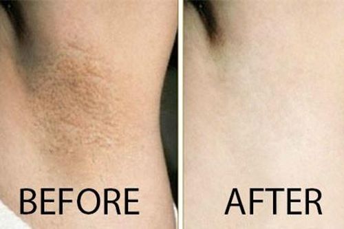 Mẹo trị thâm nách trong mùa hè giúp chị em tự tin diện váy ngắn