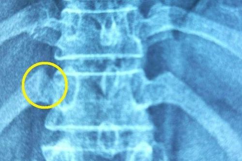 Bị gãy xương sườn vì đi bấm huyệt, bẻ khớp