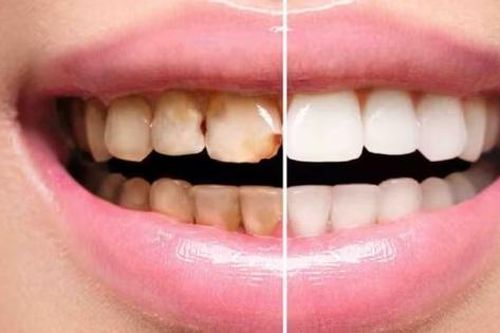 Cách phòng ngừa viêm lợi hiệu quả