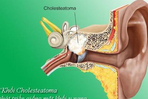 Tai chảy mủ hôi thối kèm đau đầu, nghe kém đề phòng viêm tai nguy hiểm