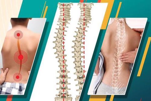 Khám, tư vấn miễn phí bệnh vẹo cột sống ở trẻ em