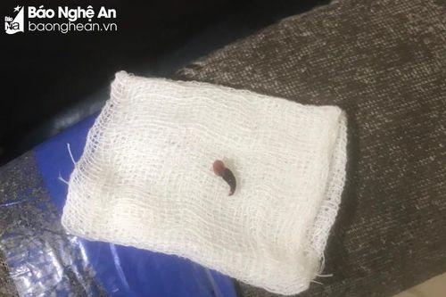 Gắp con vắt dài gần 3cm trong mũi bệnh nhân