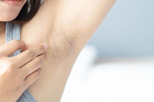 Những thói quen thường ngày gây thâm nách