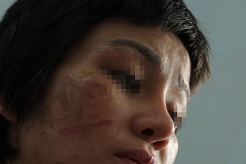 Lời kể của người phụ nữ mang thai 7 tháng bị chồng bạo hành dã man
