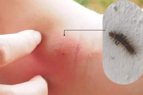 Phát ban do sâu bướm: Cách phát hiện và điều trị
