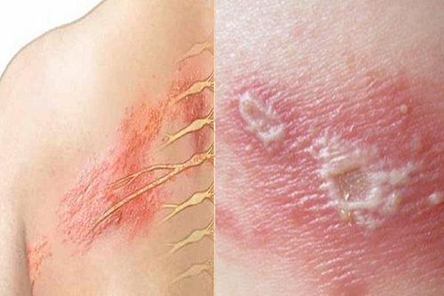 Các bệnh da do virus hay gặp vào mùa nắng nóng