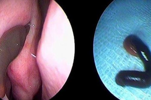 Con vắt dài gần 3cm trong mũi người đàn ông