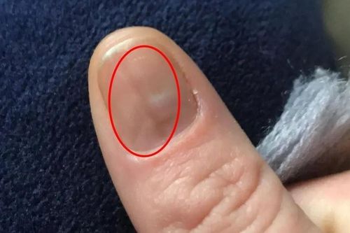 Phát hiện ung thư qua vết bầm trên móng tay
