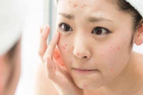 Nhóm thực phẩm ngừa mụn hiệu quả trong mùa hè