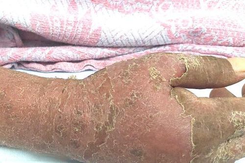 Hình ảnh bàn tay gây ám ảnh của bệnh nhân dị ứng thuốc kháng lao