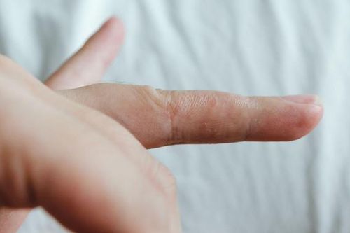 Bệnh chàm tổ đỉa gây gổi mụn nước ở tay vào mùa hè