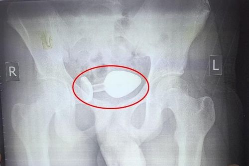 Thiếu niên 15 tuổi nhập viện vì kẹt dị vật trong hậu môn