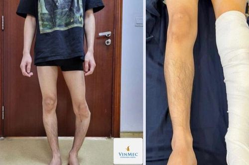 'Nắn thẳng' cẳng chân cho bệnh nhân có góc vẹo chân hơn 50 độ